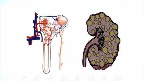 多囊肝多囊肾最新治疗方法揭秘，小巷深处的秘密疗法探索